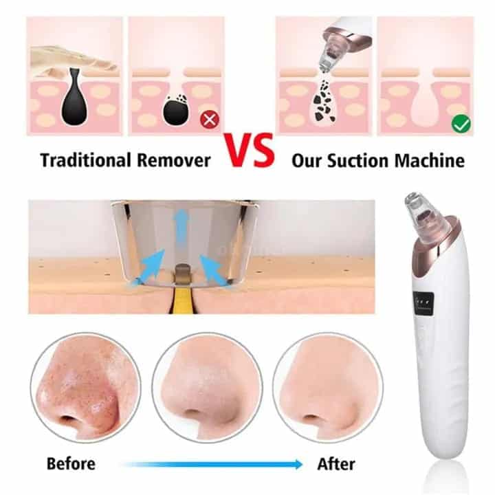 Electric Blackhead Remover – Rechargeable Pore Vacuum Cleaner